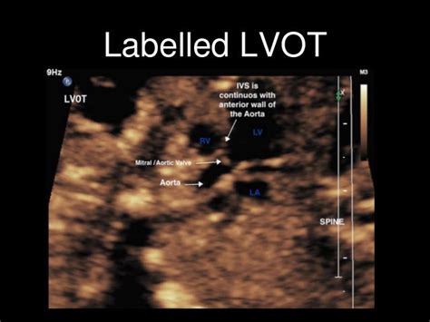 Labelled fetal heart ultrasound