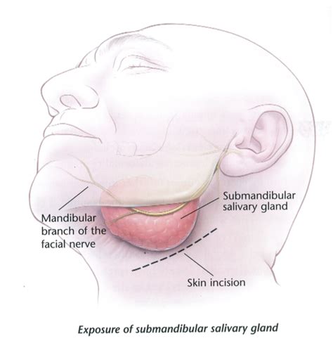 Excision submandibular gland (removing the large saliva gland from ...