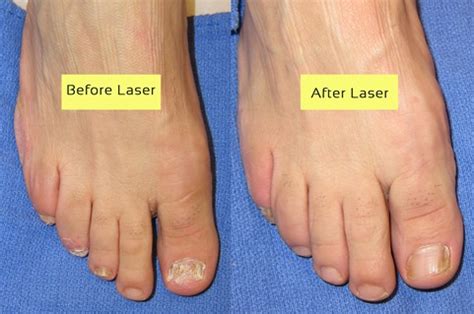 Cutera Laser for nail fungus before and after pictures - Toenail Fungus NYC Laser