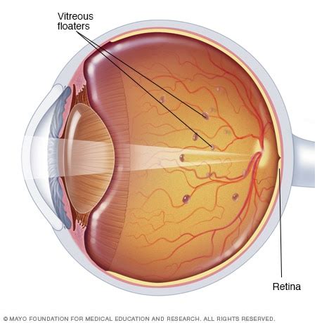 Eye floaters - Symptoms and causes - Mayo Clinic