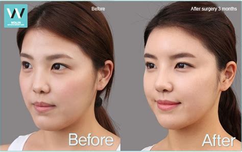 Short nose correction plastic surgery in Korea