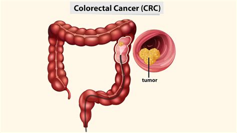 Rectal Cancer: Symptoms, Causes And Treatment | OnlyMyHealth