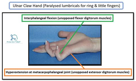 Claw Hand & Ulnar Paradox » How To Relief