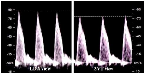 Ductus Arteriosus Ultrasound