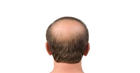 How to Regrow Hair on a Bald Spot? 25 Science-Backed Methods to try!