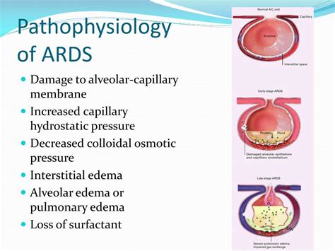 PPT - RESPIRATORY FAILURE and ARDS PowerPoint Presentation, free download - ID:2051116