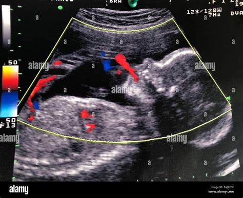 Amniotic Sac Ultrasound