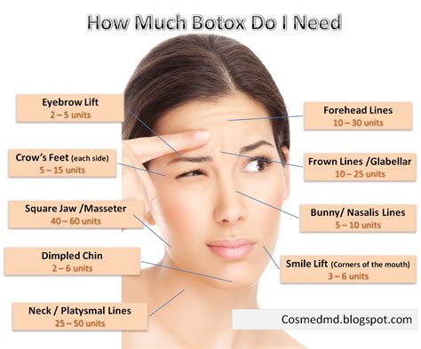 Where Can I Get Botox For Tmj Near Me - abevegedeika