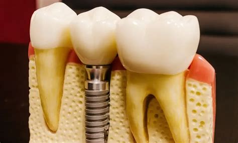 Dental Bone Graft Infection: 5 Causes You Should Look For