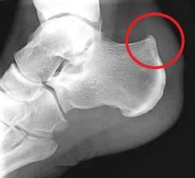 Achilles Tendinitis - OrthoInfo - AAOS