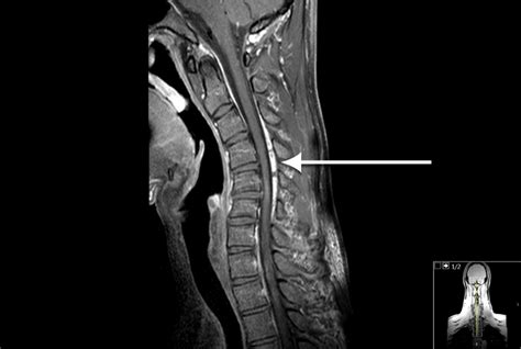 Hirayama disease; an atypical clinical manifestation of a cervical ...