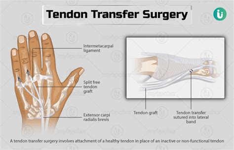 Tendon Transfer Surgery: Procedure, Purpose, Results, Cost, Price