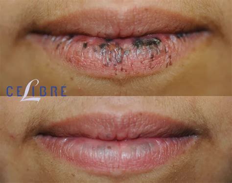 Lips Spots Removal : Dark And Sun Spots On Lips