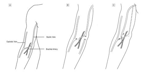 Schematic diagrams showing the normal anatomy (A) and the procedure.... | Download Scientific ...