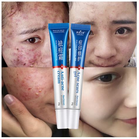ISILANDON Face Care Clear Vanishing Acne Treatment Cream+Acne Scars ...