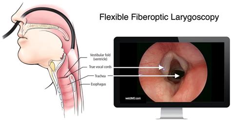 Laryngopharyngeal Reflux Disease (LPR) | Fort Worth ENT & Sinus