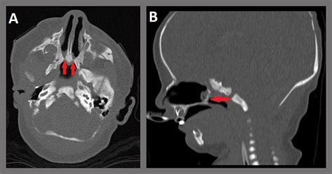 Cureus | Surgical Management of Choanal Atresia: Two Classic Cases and Review of the Literature