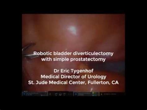 Robotic bladder diverticulectomy with simple prostatectomy - YouTube