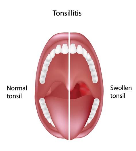 Healthy Tonsils Vs Tonsillitis