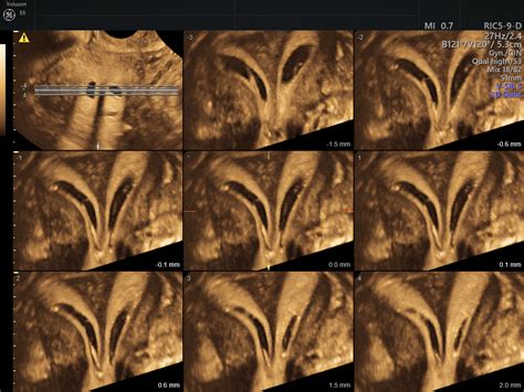 Uterine Malformation: Better Diagnosis With 3D Ultrasound | Empowered ...