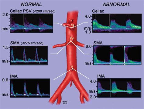 Duplex Ultrasound of the Mesenteric Vessels | SpringerLink