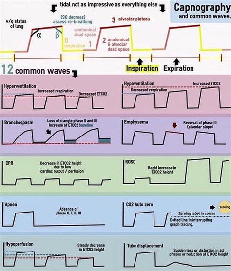 end tidal co2 waveforms - Lot Of Things Newsletter Image Library