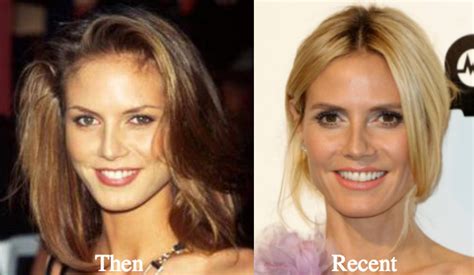 Heidi Klum Plastic Surgery Before and After Photos - Latest Plastic Surgery Gossip And News ...