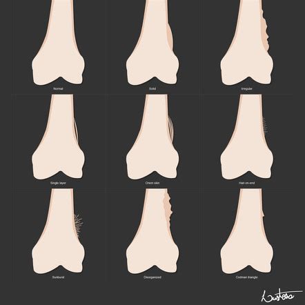 Periosteal reaction | Radiology Reference Article | Radiopaedia.org