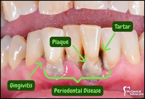 What Does Gingivitis Look Like? (20 Gum Disease Pictures)