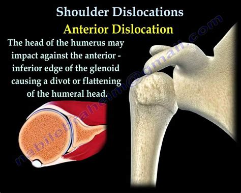 Anterior Shoulder Dislocation