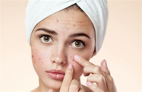 Acne/Pimple Treatment - Welona