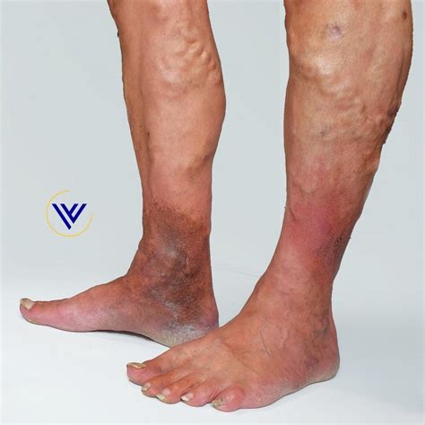 What Should I Do If My Varicose Veins Start to Bleed?: Center for Varicose Veins: Board ...