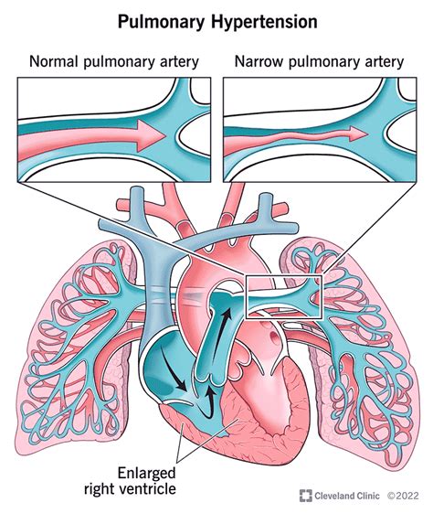 Pulmonary Hypertension: Symptoms, Treatment