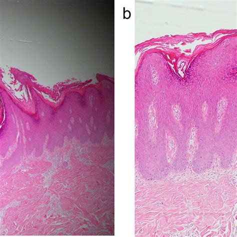 K17 expression is elevated in PN lesional skin. (a) Protein levels of ...