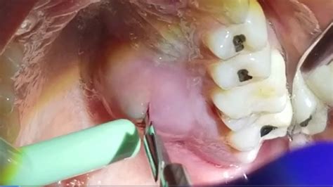 Gum Abscess! All About Dental Abscesses, Tooth Abscesses and Drainage - YouTube