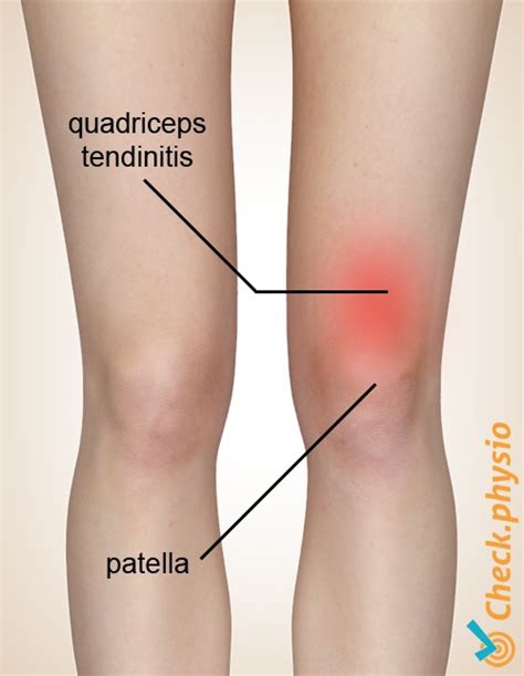 Quadriceps tendinitis | Physio Check