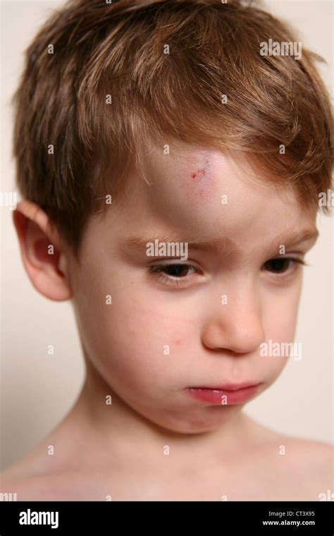 CHILD WITH HEMATOMA Stock Photo - Alamy