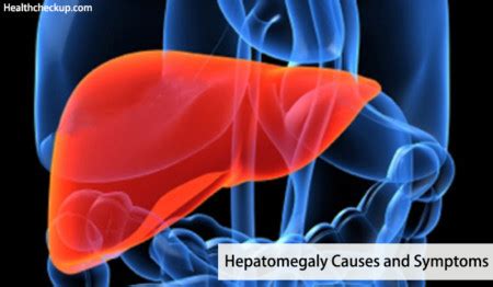 Mild, Massive, Tender Hepatomegaly Causes and Symptoms