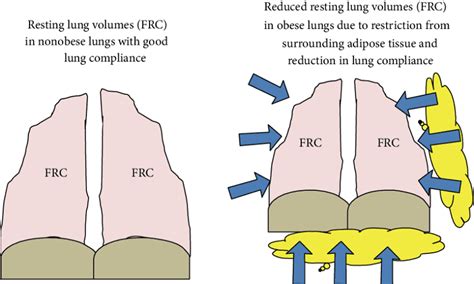 Functional Residual Capacity - What All You Need To Know