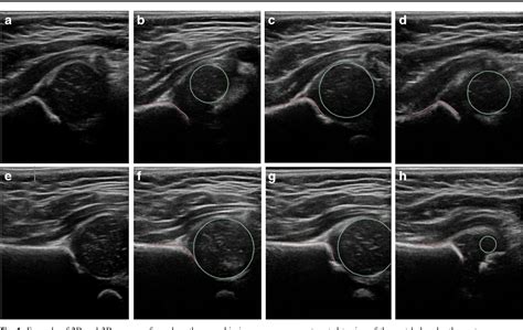 Reliability of 2D and 3D ultrasound for infant hip dysplasia in the hands of novice users ...