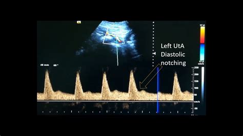 Uterine artery Doppler - YouTube