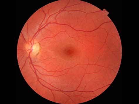 Ophthalmoscopic Functioning and Examination of the Fundus | Physical ...