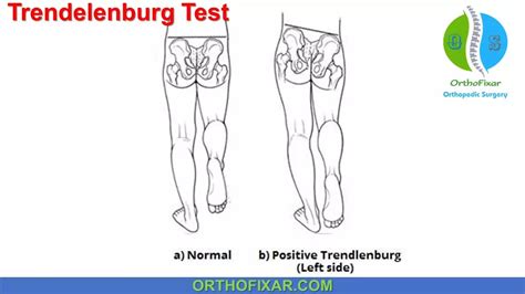 Left Side Trendelenburg Position