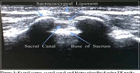 Figure 3 from Comparison of pediatric caudal block with ultrasound ...