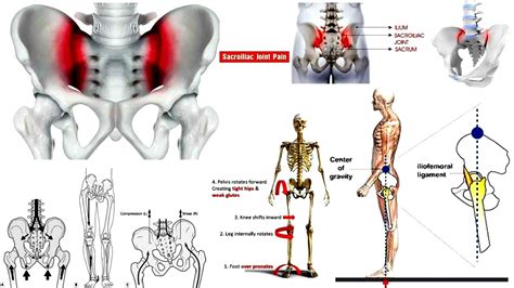 Sacroiliac Joint Dysfunction | SI Joint Pain | Sacroiliitis | SI Joint Oedema | Symptoms ...