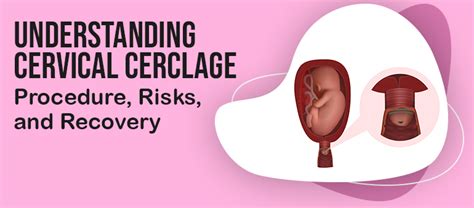 Understanding Cervical Cerclage: Procedure, Risks, and Recovery