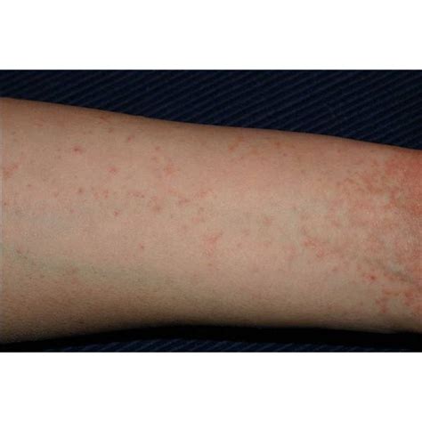 Signs & Symptoms of Human Skin Mites | Healthfully