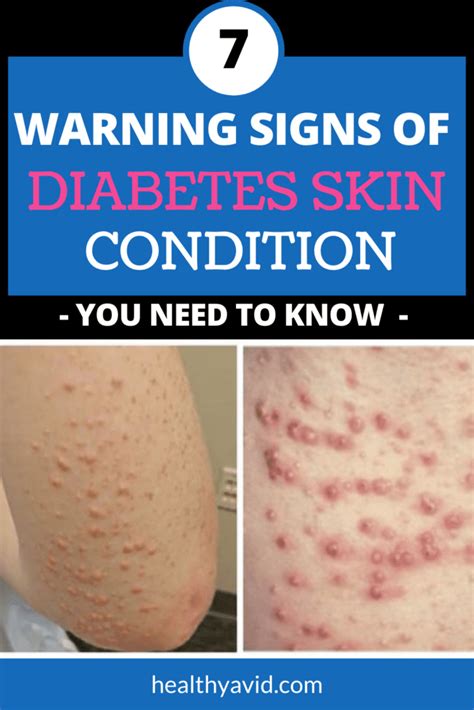 7 Diabetes Skin Problems and Warning Signs You Should Know