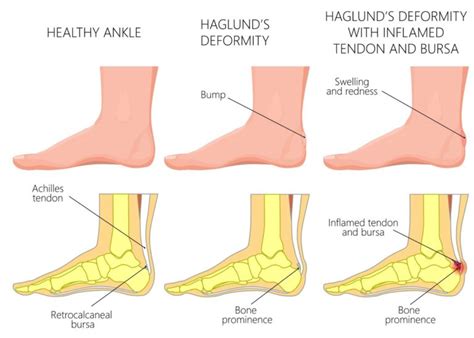 Haglund's Deformity - Plantar Fascia Institute of MN