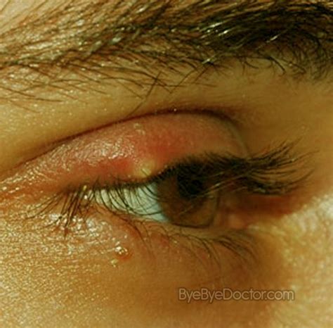 Stye Eye – Symptoms, Causes, Pictures, Treatment, Prevention